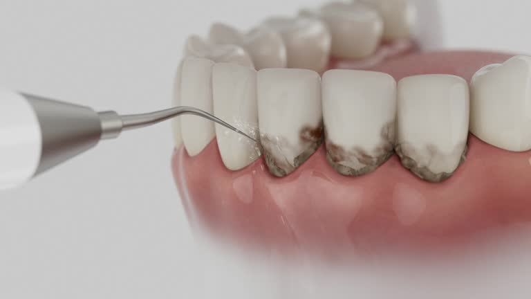 Trusted Wisdom Tooth Removal service in Butte, AK - Dentist Open Now